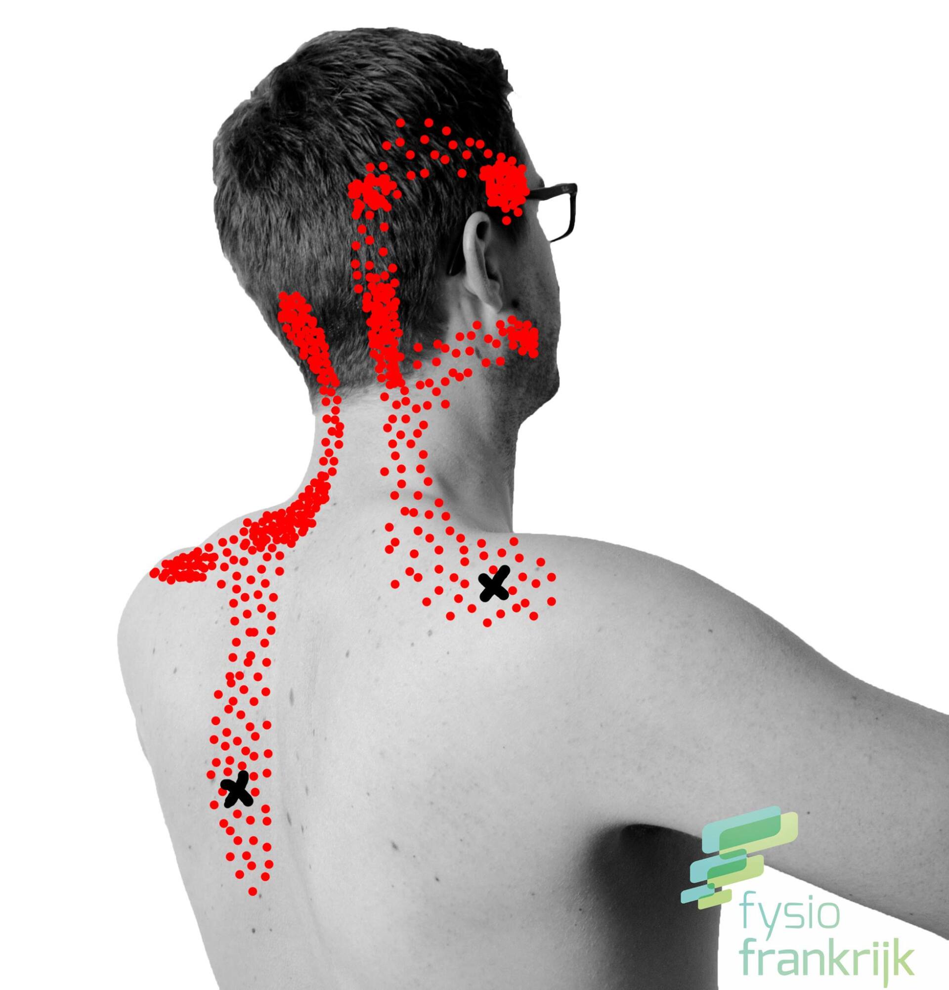 Dry Needling