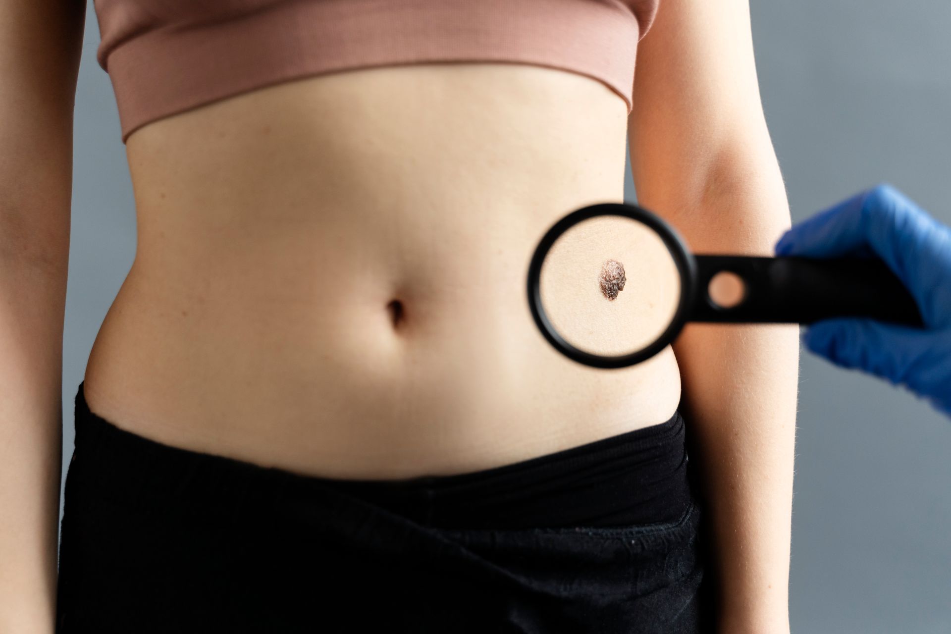 Doctor examining a mole on a person's abdomen with a magnifying glass.