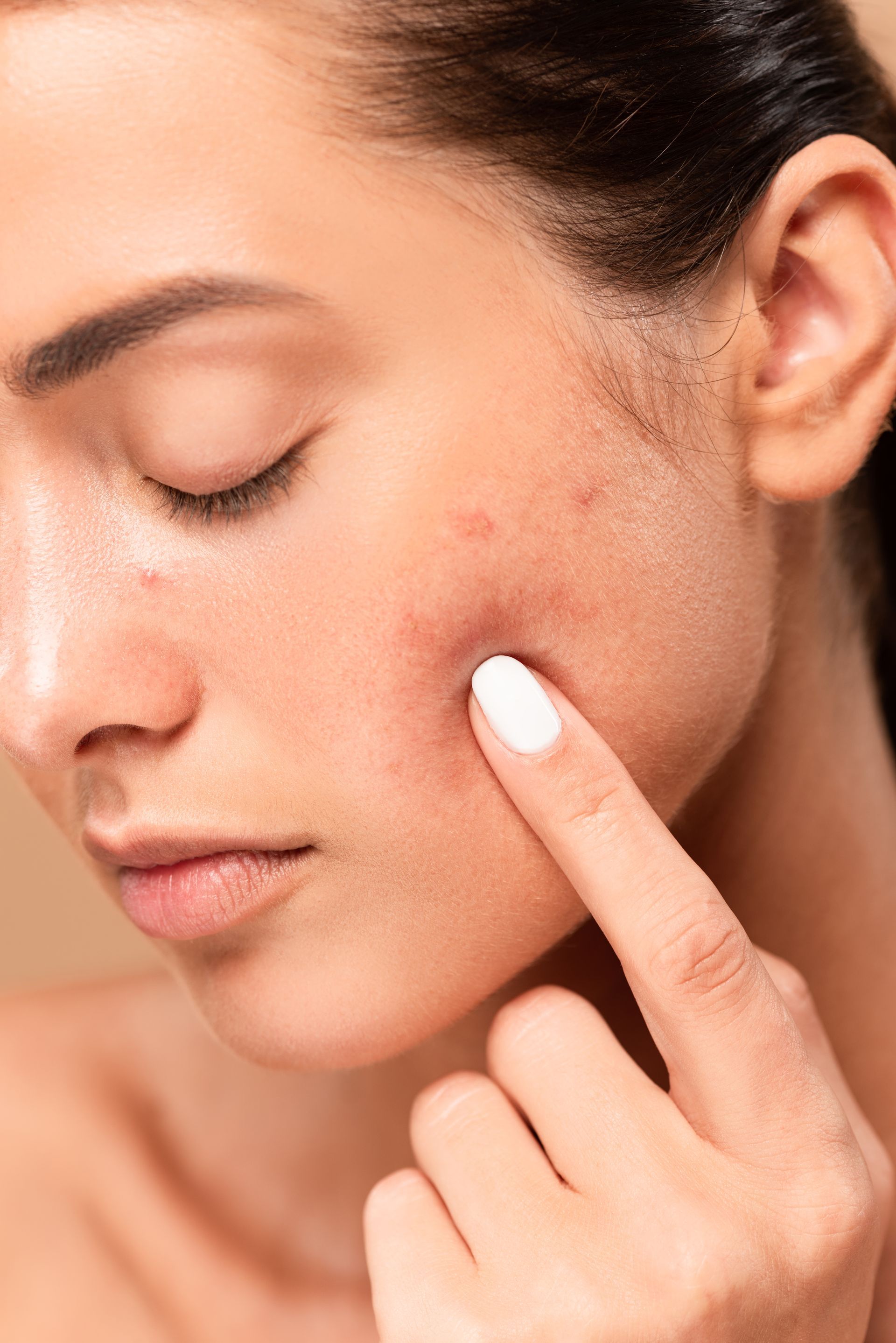Woman touching cheek with visible acne; neutral background.