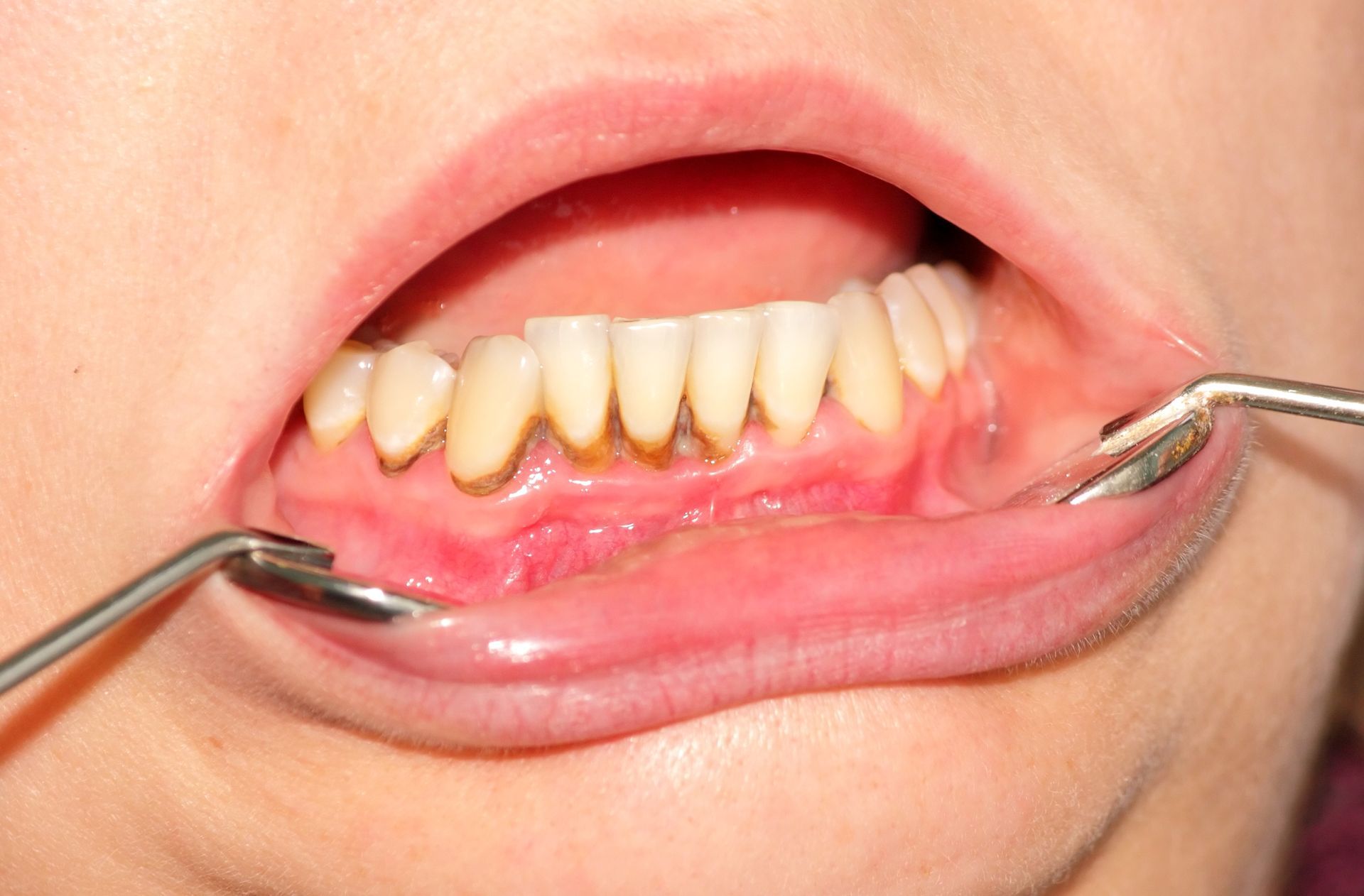 Gum Disease
