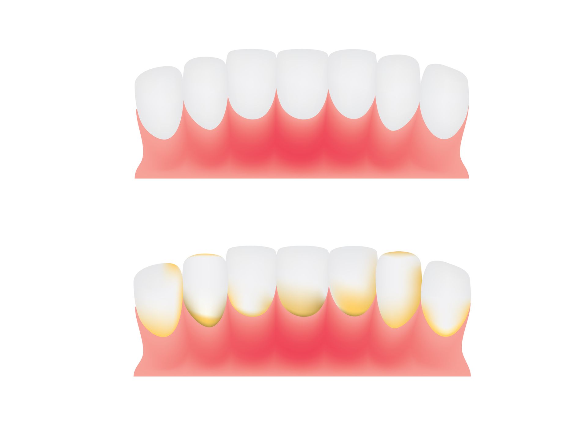 Teeth Discoloration