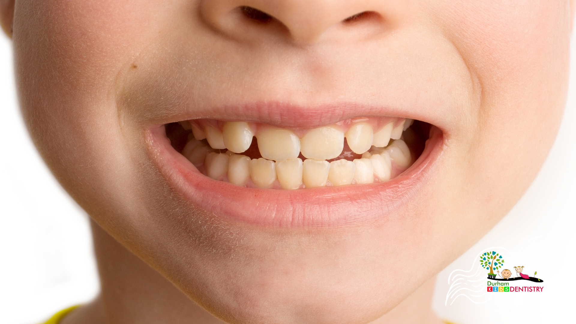 A close up of a child 's mouth showing his teeth.