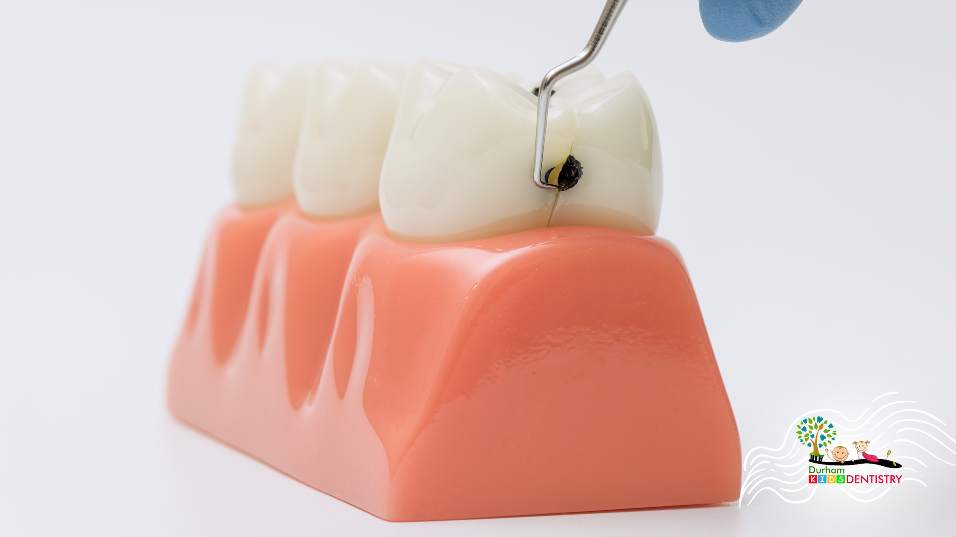 Dental model with toothbrush cleaning a tooth, showing a cavity on a white background