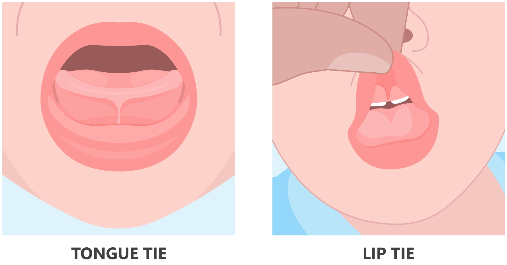 Tongue tie | Lip-tie | Frenectomy | Pediatric Dental Specialist | Pediatric Dentist | Photos Of Our Office | Durham Kids Dentistry | Pediatric Dentist In Whitby