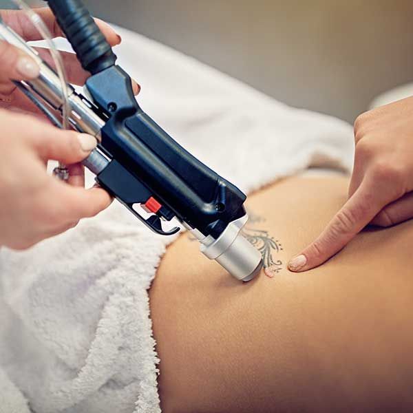 LASER TATTOO REMOVAL