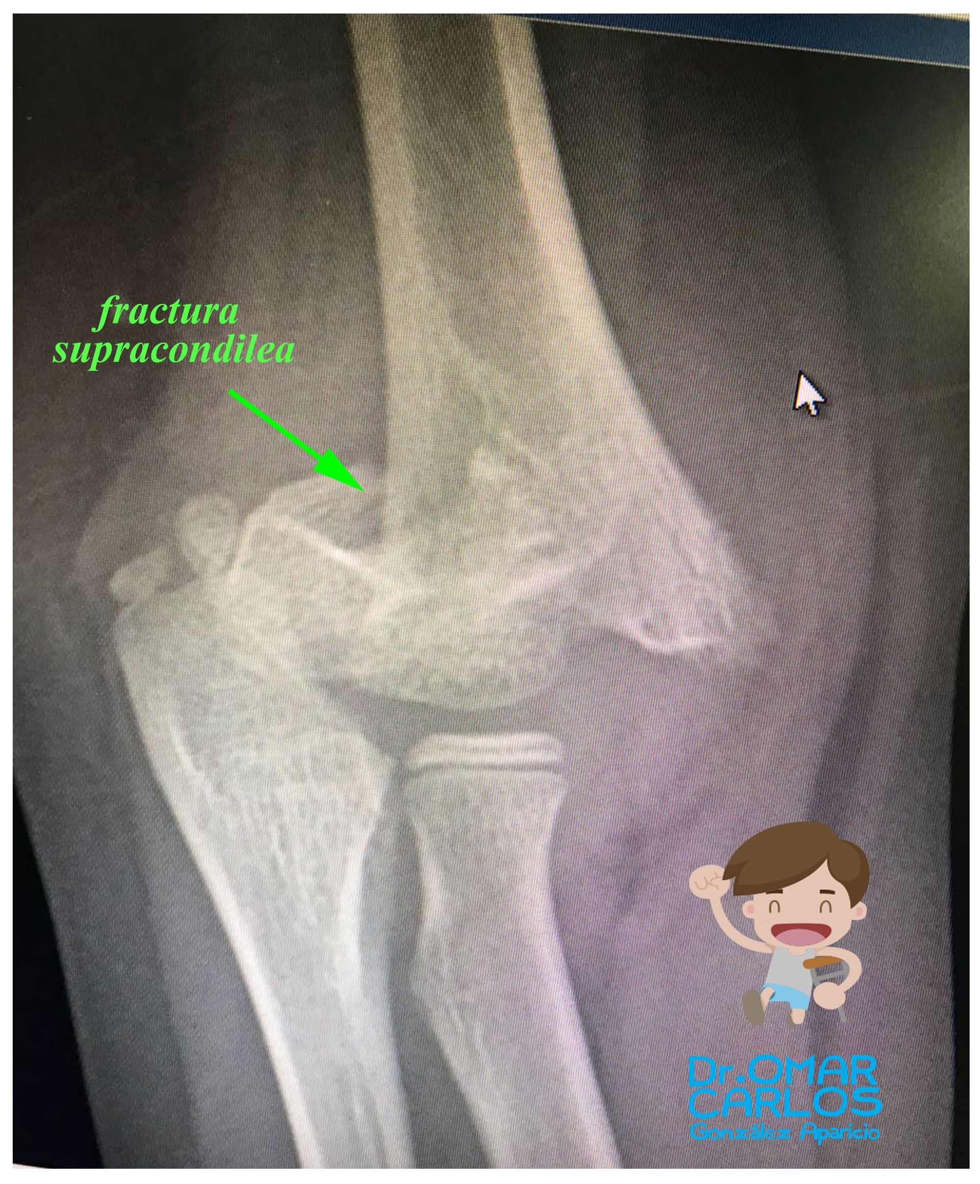 Fracturas supracondileas de humero