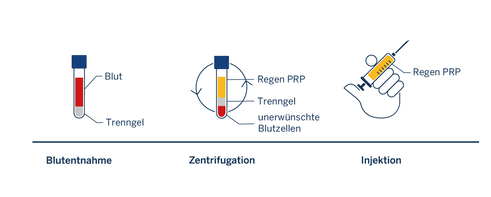 Schema der Blutverarbeitung für PRP-Injektionen: Blutentnahme, Zentrifugation und Injektion.