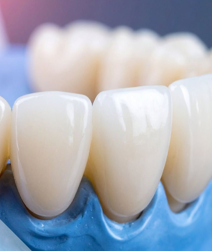 Primo piano di denti bianchi con linea gengivale blu, modello per esposizione odontoiatrica