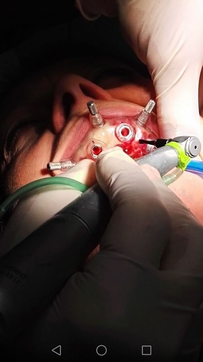 Mani guantate che lavorano sul viso di un paziente sotto una forte luce chirurgica, con tubi e strumenti ben visibili.