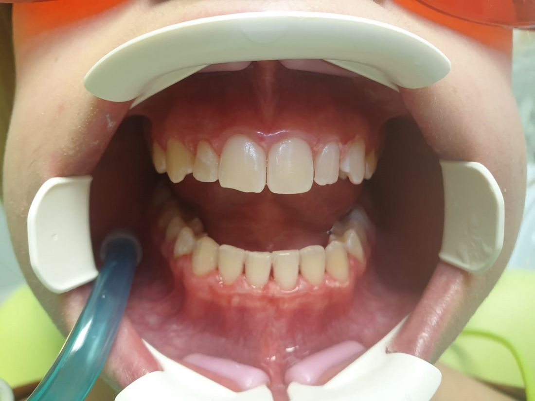 Impianti dentali
