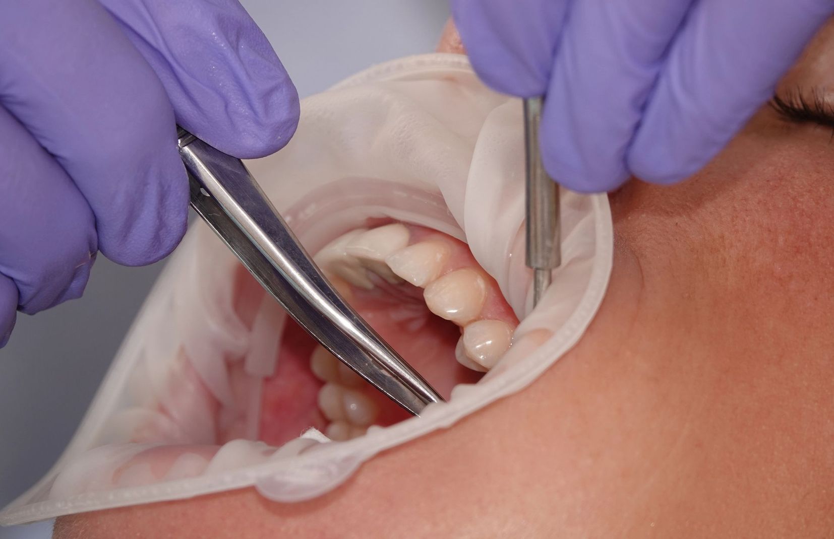 Dentista che utilizza strumenti metallici e un divaricatore per le guance all'interno della bocca aperta di un paziente.