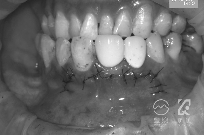 治療完縫合