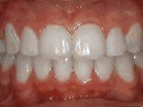 Lingual Braces