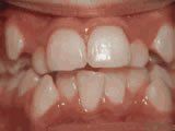 Lingual Braces