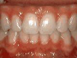 Lingual Braces