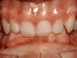 Lingual Braces