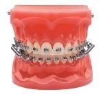Lingual Braces