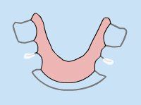 Lingual Braces