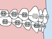 Lingual Braces