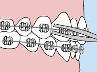 Lingual Braces