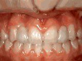 Lingual Braces