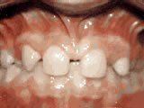 Lingual Braces