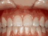 Lingual Braces