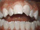 Lingual Braces