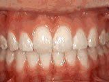 Lingual Braces