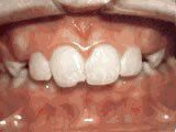 Lingual Braces