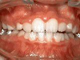 Lingual Braces