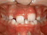 Lingual Braces