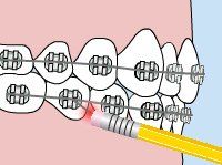 Lingual Braces