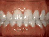 Lingual Braces