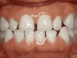 Lingual Braces