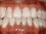 Lingual Braces