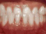 Lingual Braces