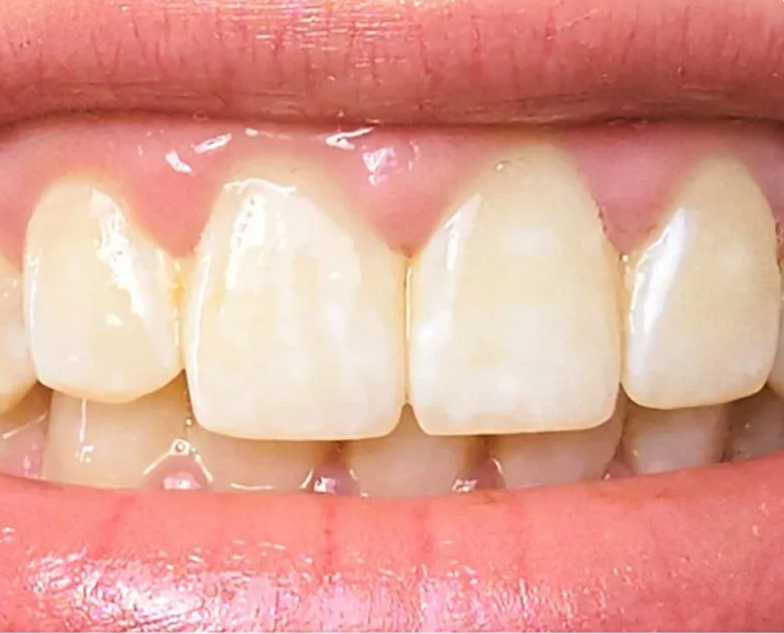 Close-up of a smile showing white front teeth and pink gums