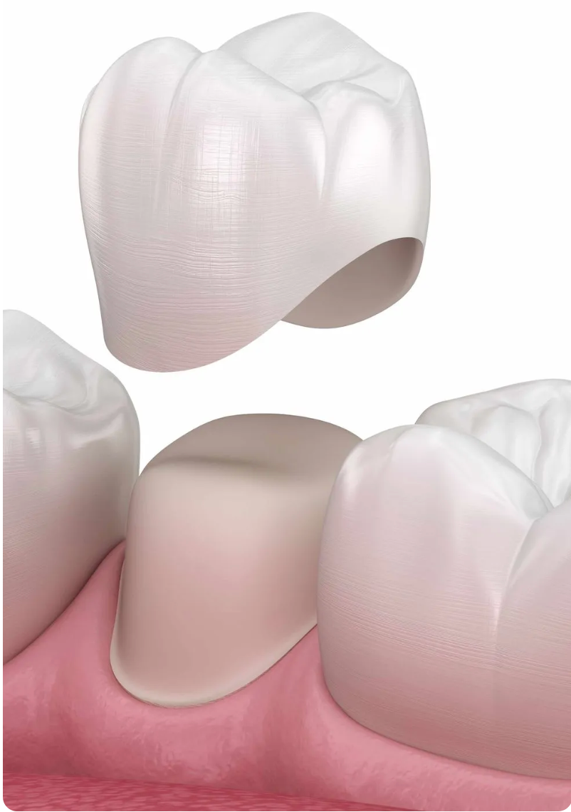 Dental crown above a tooth implant with pink gum background