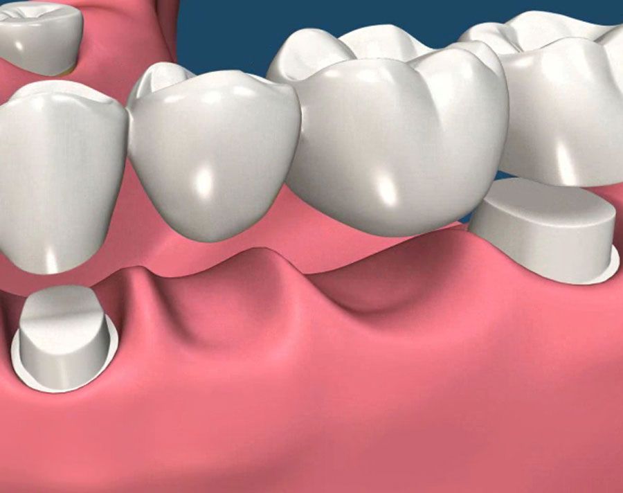 Illustration of lower molars with pink gums and dental crowns or implants