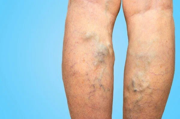 Un primer plano de las piernas de una persona con venas varicosas sobre un fondo azul.