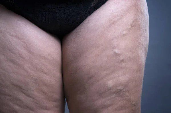 Un primer plano de las piernas de una mujer con venas varicosas.