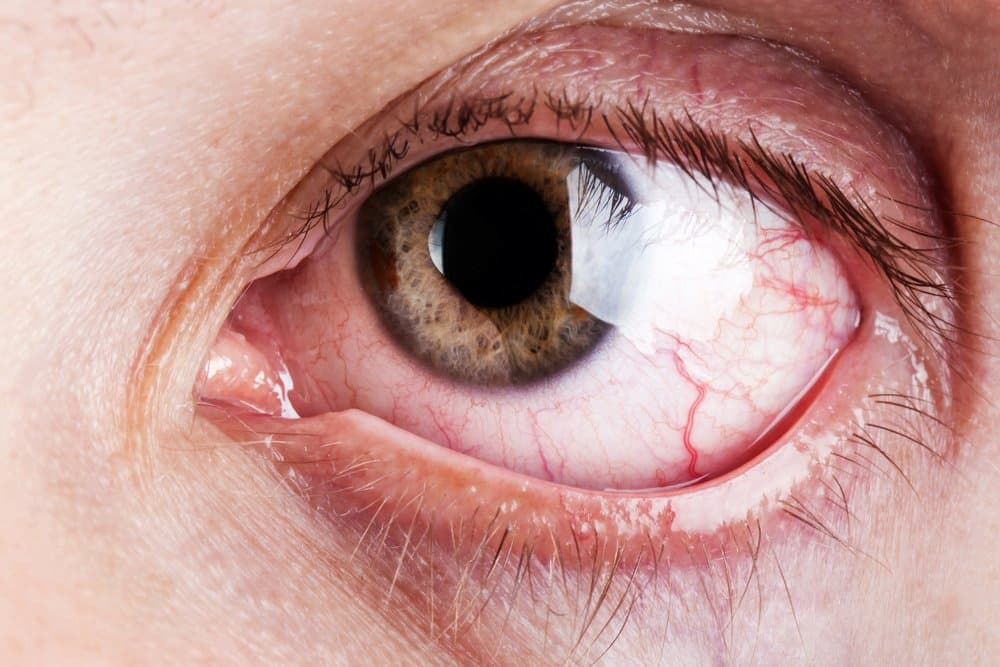 Dry Eyes — Optometrist in Banora Point, NSW