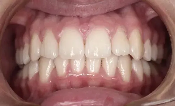 After Deep Bite — Doncaster, VIC — E Orthodontics