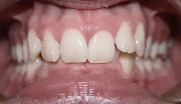 Before Deep Bite — Doncaster, VIC — E Orthodontics