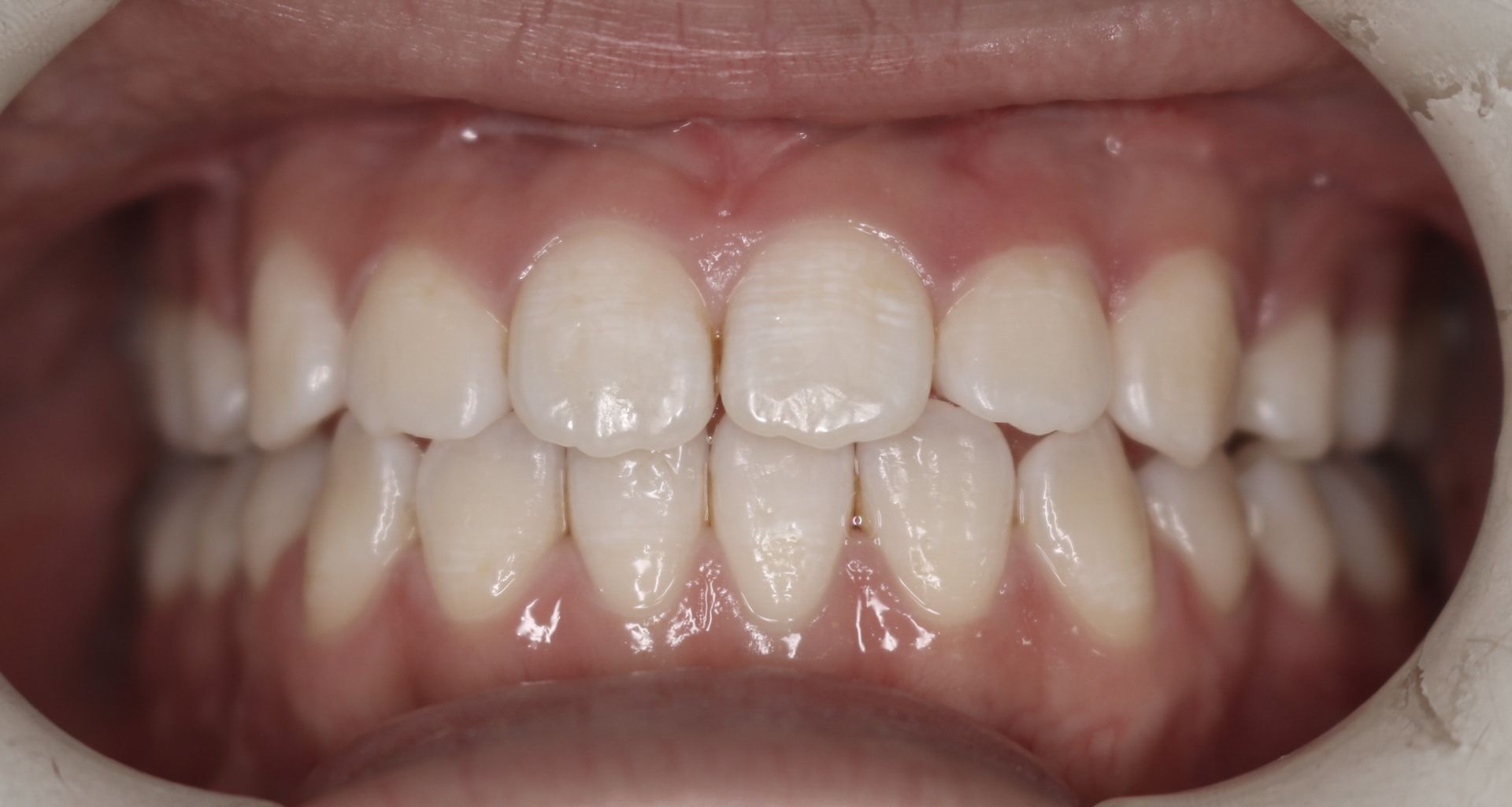 After Cross Bite — Doncaster, VIC — E Orthodontics