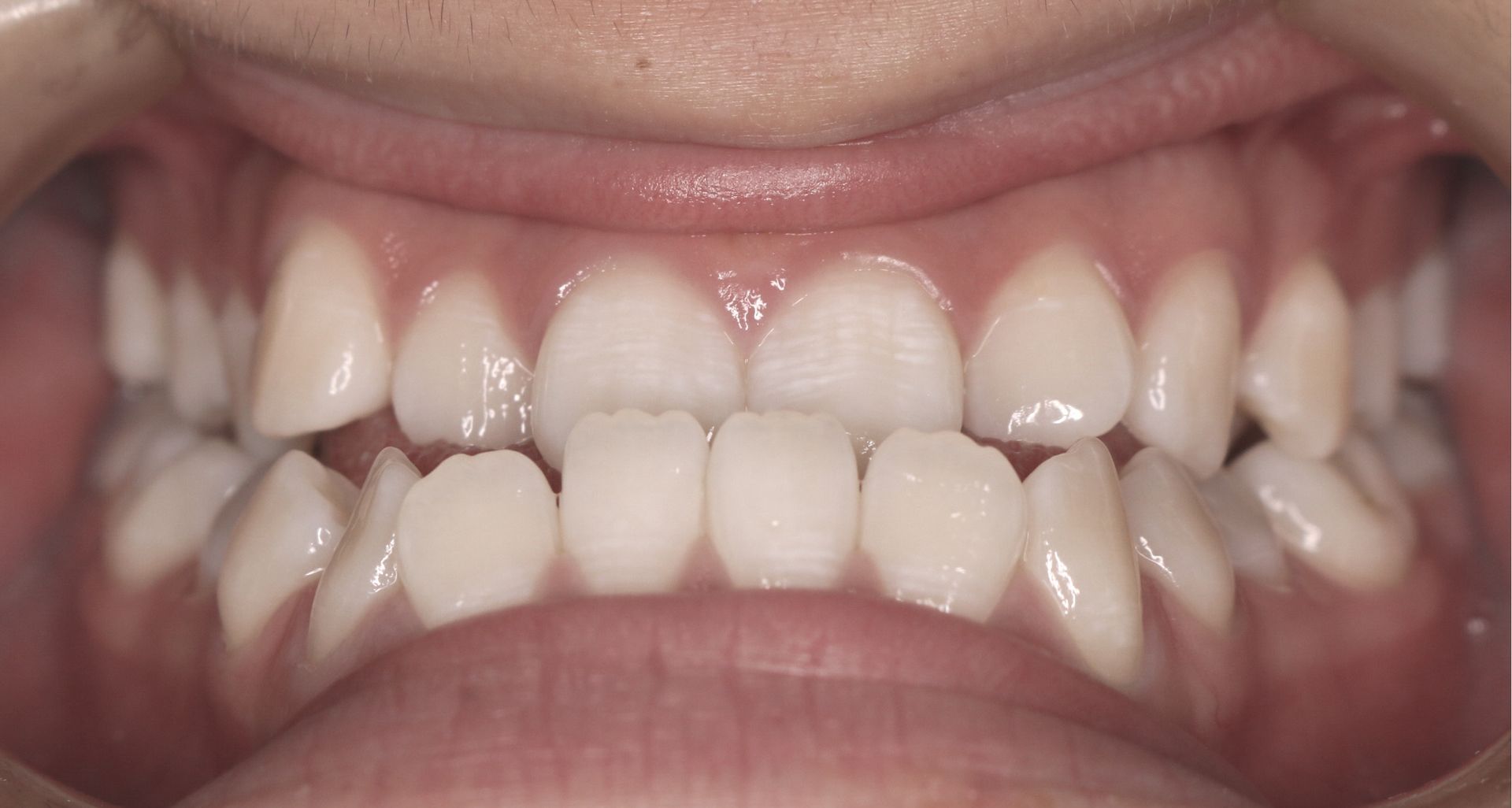 Before Cross Bite — Doncaster, VIC — E Orthodontics