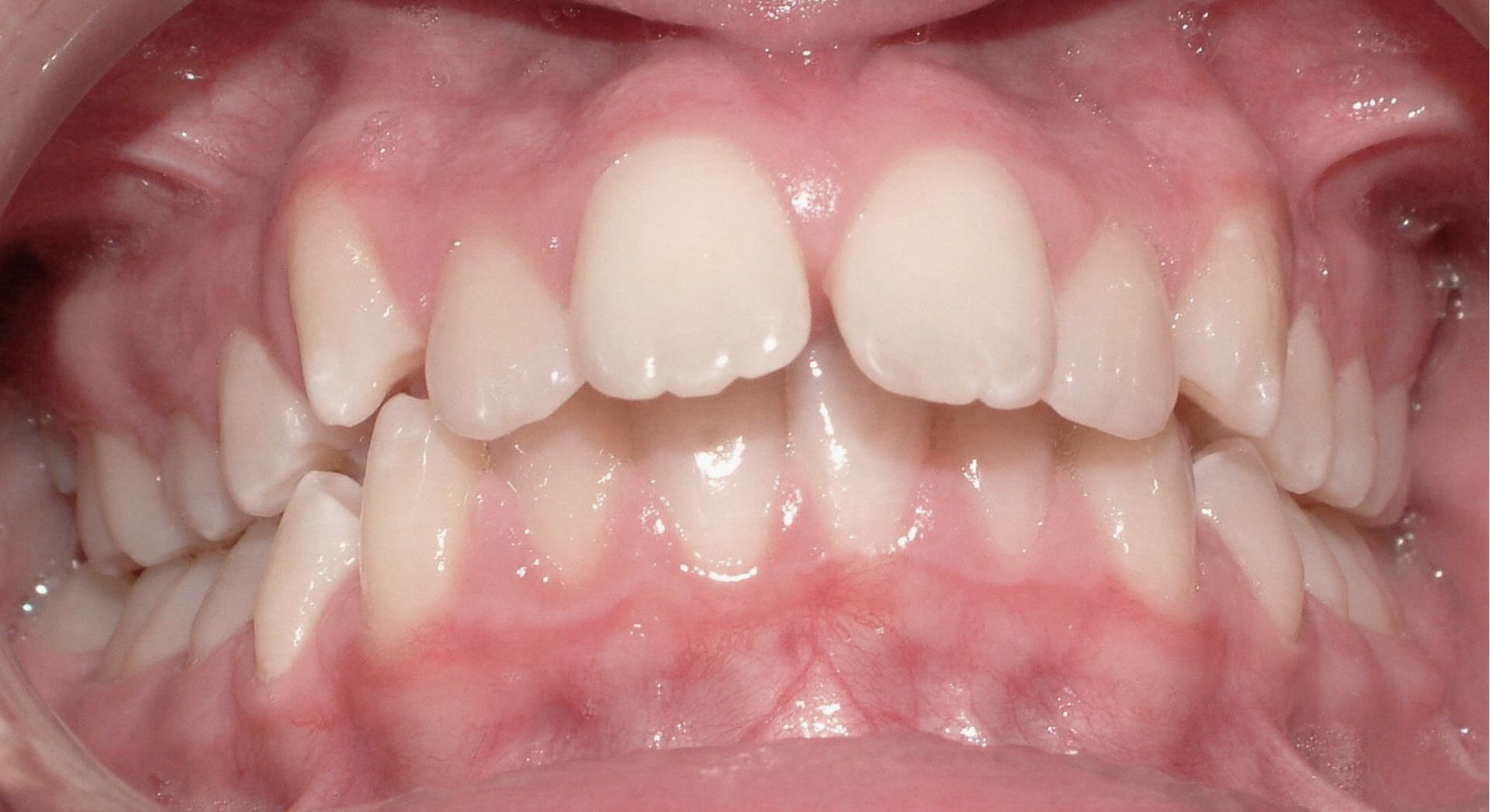 Before Protruding Upper Teeth— Doncaster, VIC — E Orthodontics