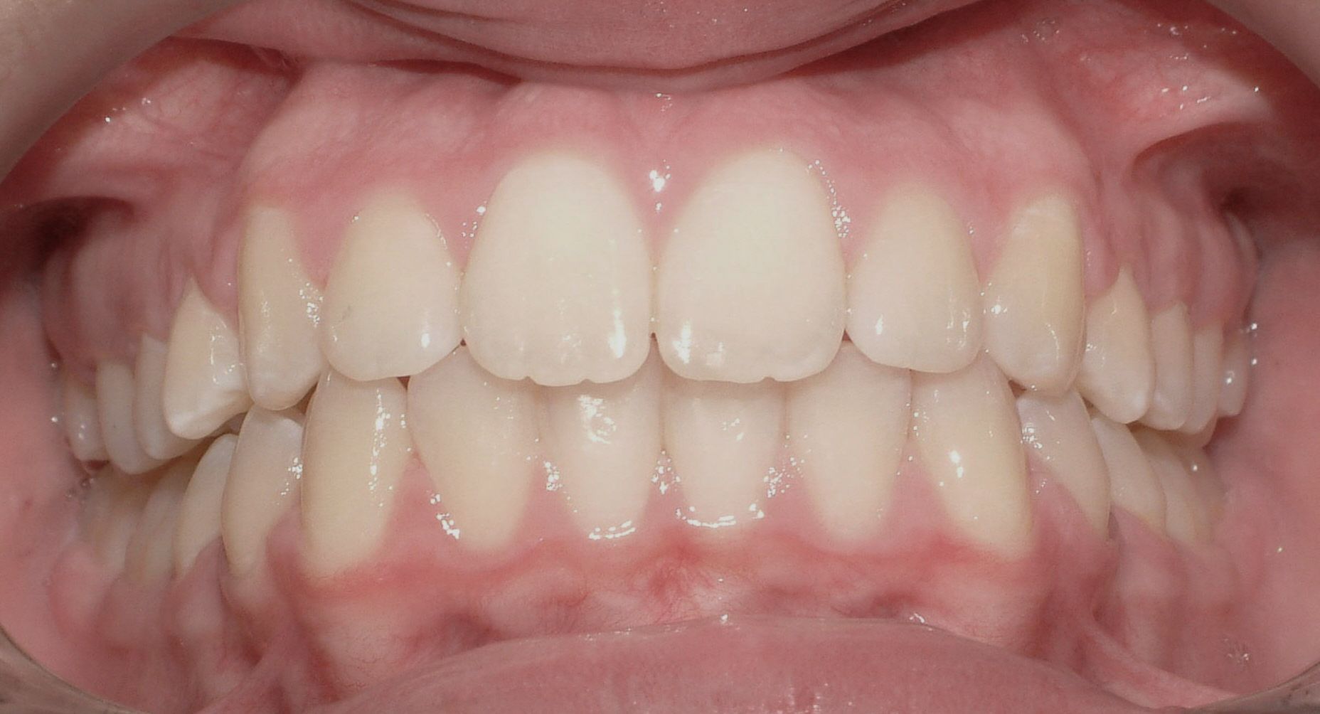 After Protruding Upper Teeth — Doncaster, VIC — E Orthodontics