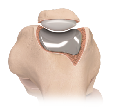 Bone resurfacing preserves the bone Bone resurfacing preserves the bone